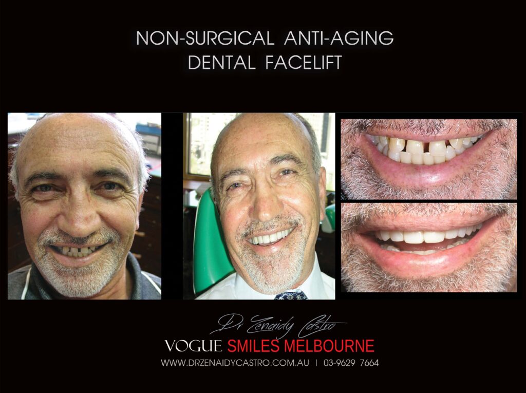 AFFORDABLE-COSMETIC-DENTISTRY-MAKEOVER-WITH-DENTAL-BONDING-MELBOURNE-55-scaled.jpg