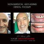 AFFORDABLE-COSMETIC-DENTISTRY-MAKEOVER-WITH-DENTAL-BONDING-MELBOURNE-55-scaled.jpg