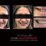 AFFORDABLE-COSMETIC-DENTISTRY-MAKEOVER-WITH-DENTAL-BONDING-MELBOURNE-7.jpg