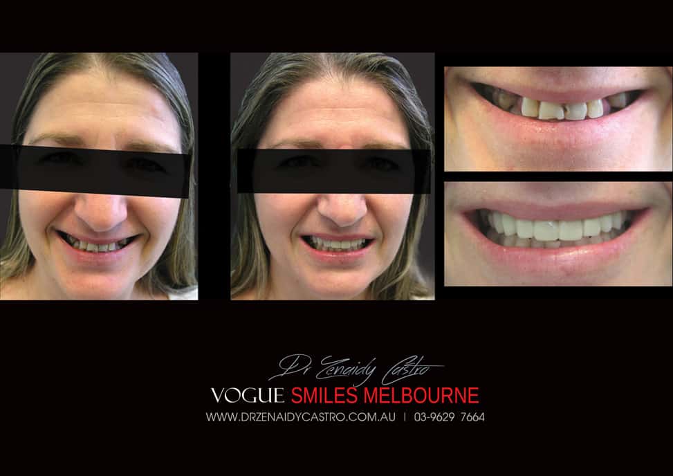 AFFORDABLE-COSMETIC-DENTISTRY-MAKEOVER-WITH-DENTAL-BONDING-MELBOURNE-7.jpg