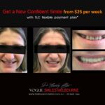 AFFORDABLE-COSMETIC-DENTISTRY-MAKEOVER-WITH-DENTAL-BONDING-MELBOURNE-8.jpg