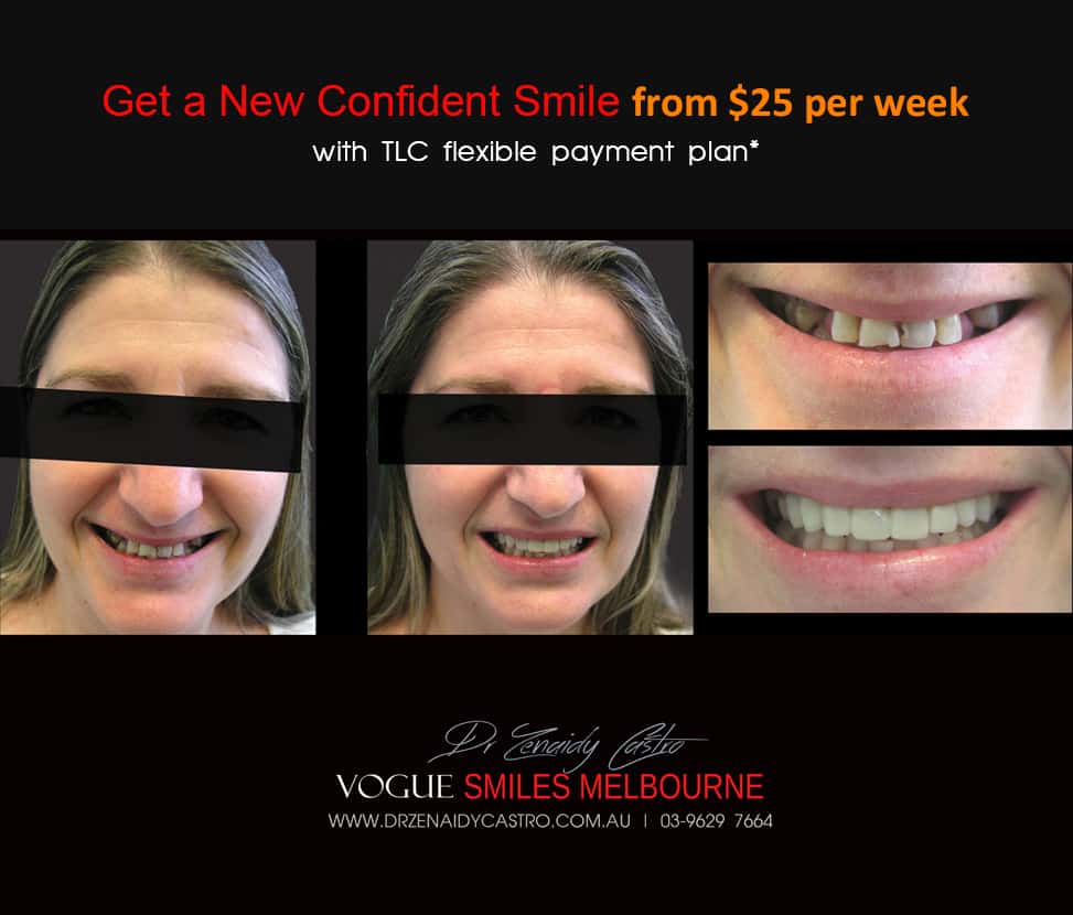 AFFORDABLE-COSMETIC-DENTISTRY-MAKEOVER-WITH-DENTAL-BONDING-MELBOURNE-8.jpg