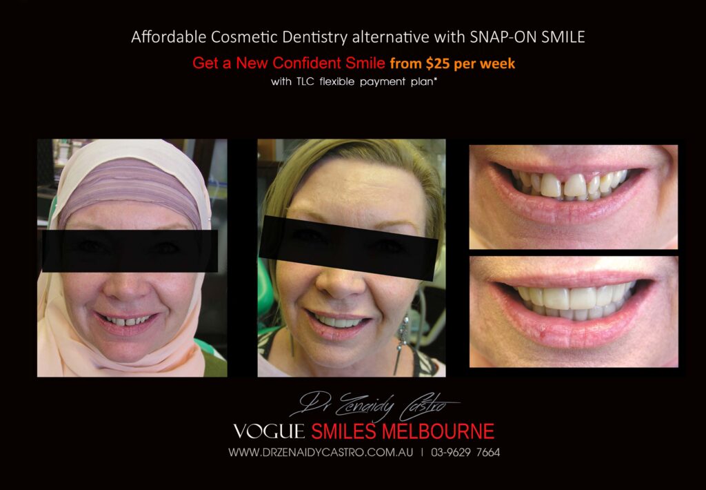 AFFORDABLE-COSMETIC-DENTISTRY-MAKEOVER-WITH-SNAP-ON-SMILE-MELBOURNE-1-scaled.jpg