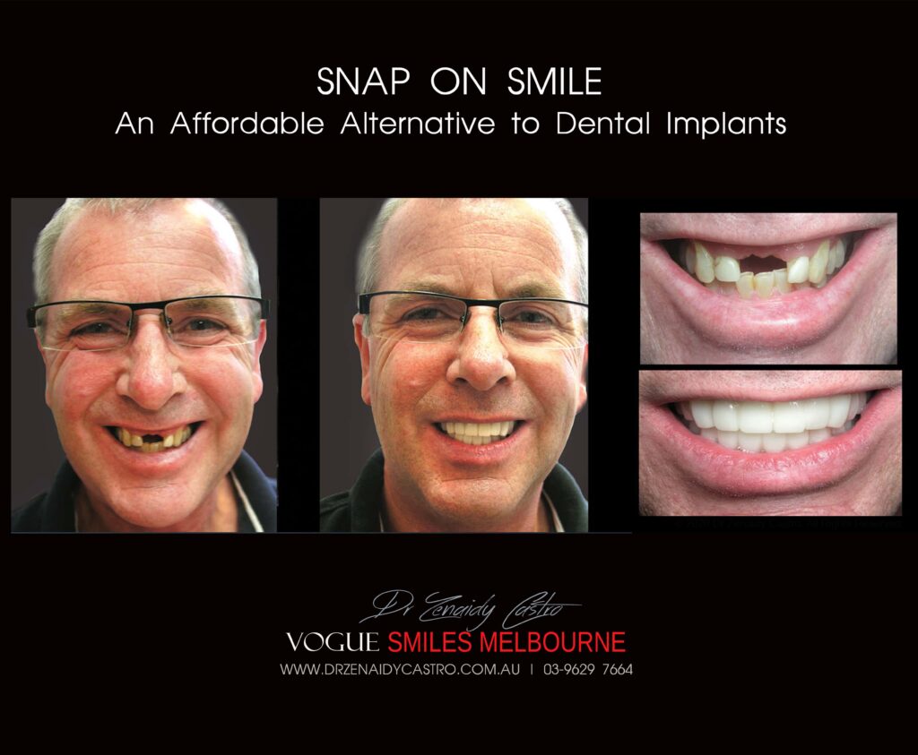 AFFORDABLE-COSMETIC-DENTISTRY-MAKEOVER-WITH-SNAP-ON-SMILE-MELBOURNE-10-scaled.jpg