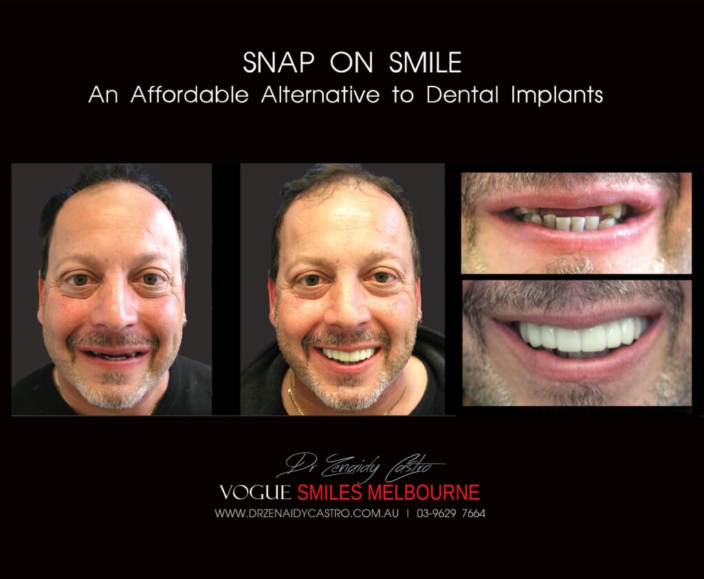 AFFORDABLE-COSMETIC-DENTISTRY-MAKEOVER-WITH-SNAP-ON-SMILE-MELBOURNE-11-scaled.jpg