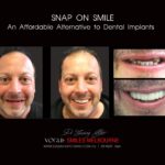 AFFORDABLE-COSMETIC-DENTISTRY-MAKEOVER-WITH-SNAP-ON-SMILE-MELBOURNE-11-scaled.jpg