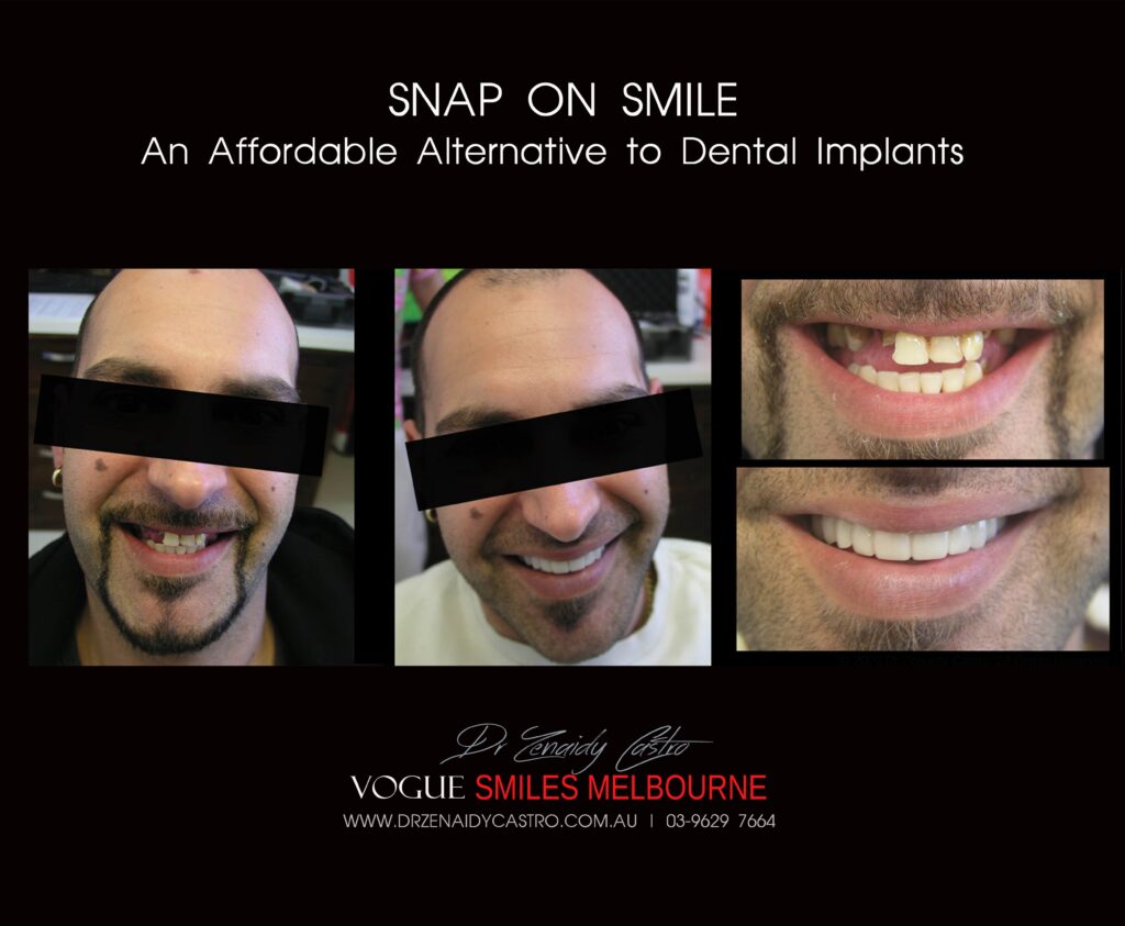 AFFORDABLE-COSMETIC-DENTISTRY-MAKEOVER-WITH-SNAP-ON-SMILE-MELBOURNE-12-scaled.jpg