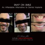 AFFORDABLE-COSMETIC-DENTISTRY-MAKEOVER-WITH-SNAP-ON-SMILE-MELBOURNE-12-scaled.jpg