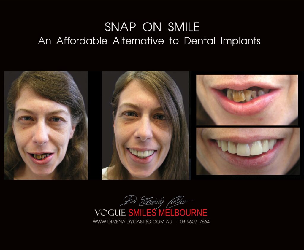 AFFORDABLE-COSMETIC-DENTISTRY-MAKEOVER-WITH-SNAP-ON-SMILE-MELBOURNE-13-scaled.jpg