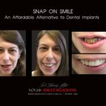 AFFORDABLE-COSMETIC-DENTISTRY-MAKEOVER-WITH-SNAP-ON-SMILE-MELBOURNE-13-scaled.jpg