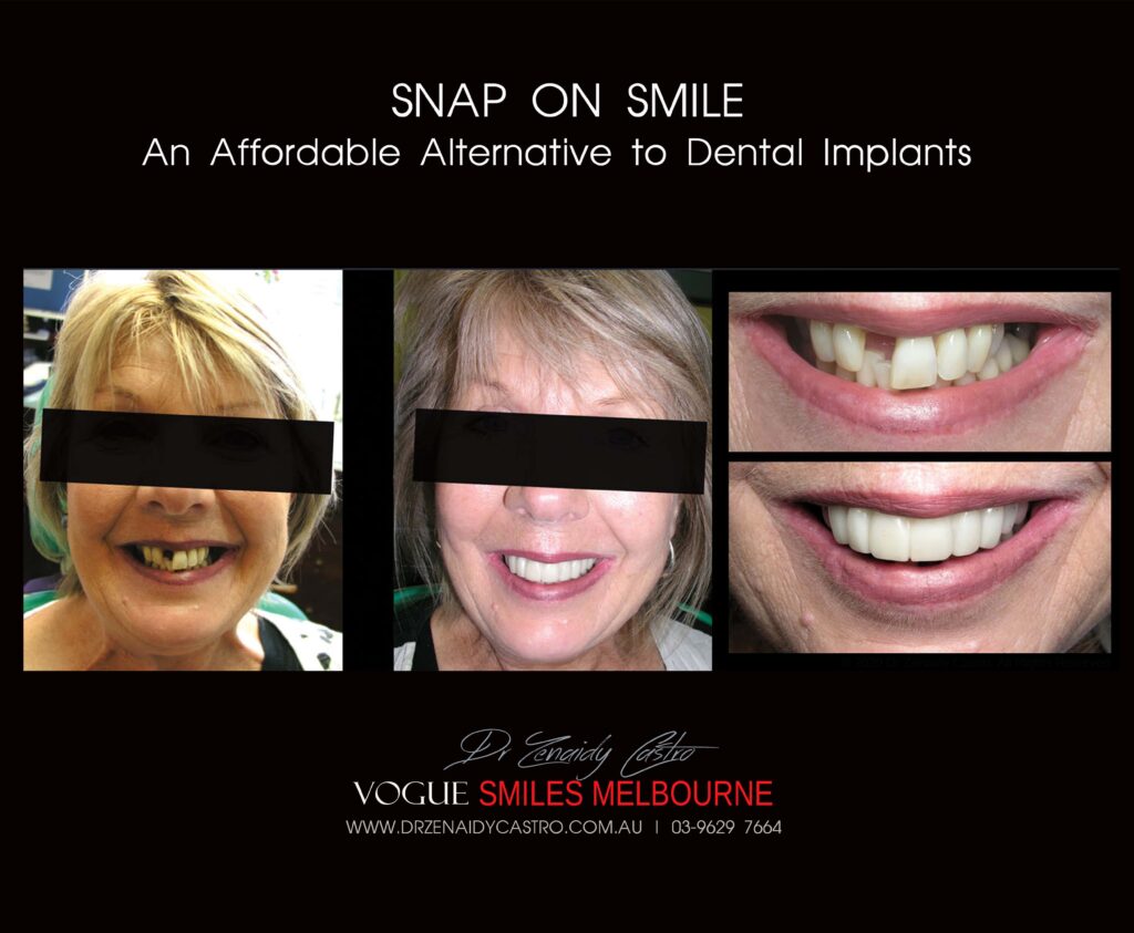 AFFORDABLE-COSMETIC-DENTISTRY-MAKEOVER-WITH-SNAP-ON-SMILE-MELBOURNE-14-scaled.jpg