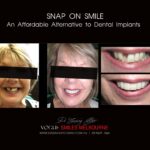AFFORDABLE-COSMETIC-DENTISTRY-MAKEOVER-WITH-SNAP-ON-SMILE-MELBOURNE-14-scaled.jpg