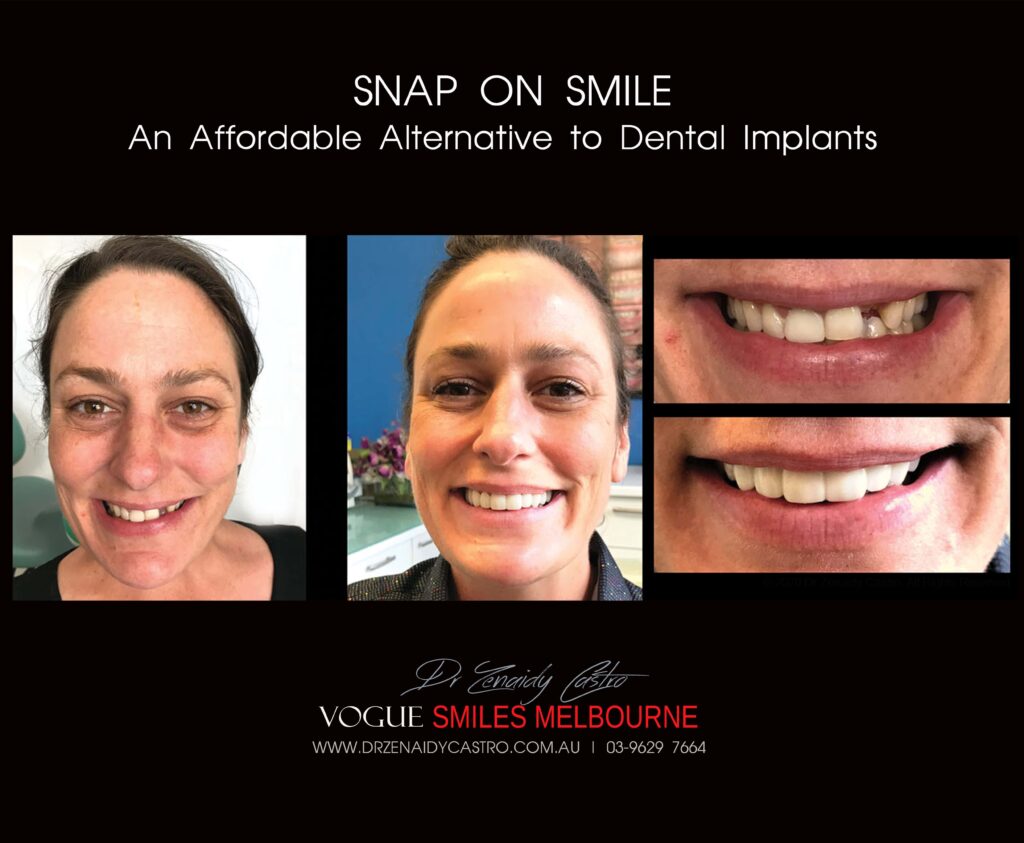 AFFORDABLE-COSMETIC-DENTISTRY-MAKEOVER-WITH-SNAP-ON-SMILE-MELBOURNE-15-scaled.jpg