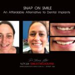 AFFORDABLE-COSMETIC-DENTISTRY-MAKEOVER-WITH-SNAP-ON-SMILE-MELBOURNE-15-scaled.jpg