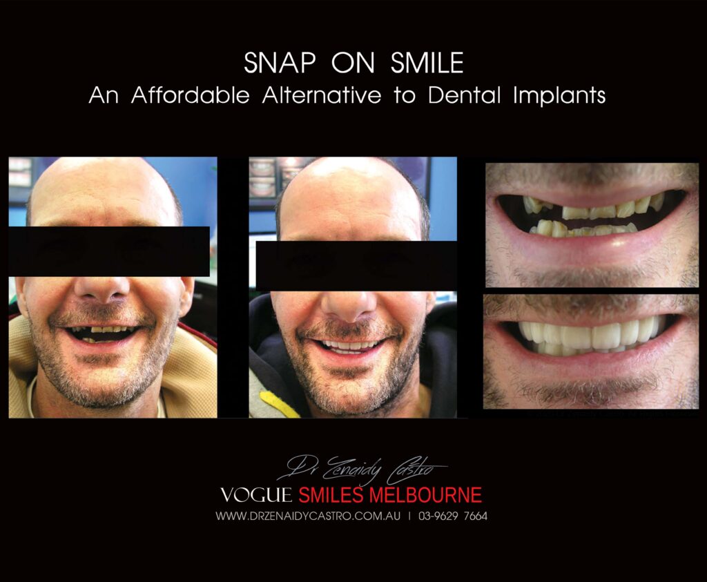 AFFORDABLE-COSMETIC-DENTISTRY-MAKEOVER-WITH-SNAP-ON-SMILE-MELBOURNE-16-scaled.jpg
