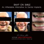 AFFORDABLE-COSMETIC-DENTISTRY-MAKEOVER-WITH-SNAP-ON-SMILE-MELBOURNE-16-scaled.jpg