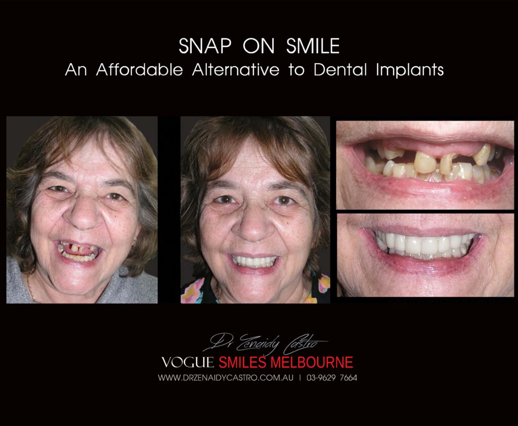 AFFORDABLE-COSMETIC-DENTISTRY-MAKEOVER-WITH-SNAP-ON-SMILE-MELBOURNE-17-scaled.jpg