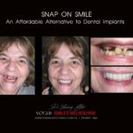 AFFORDABLE-COSMETIC-DENTISTRY-MAKEOVER-WITH-SNAP-ON-SMILE-MELBOURNE-17-scaled.jpg