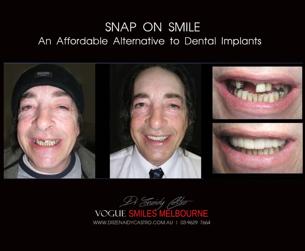 AFFORDABLE-COSMETIC-DENTISTRY-MAKEOVER-WITH-SNAP-ON-SMILE-MELBOURNE-18-scaled.jpg