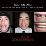 AFFORDABLE-COSMETIC-DENTISTRY-MAKEOVER-WITH-SNAP-ON-SMILE-MELBOURNE-18-scaled.jpg