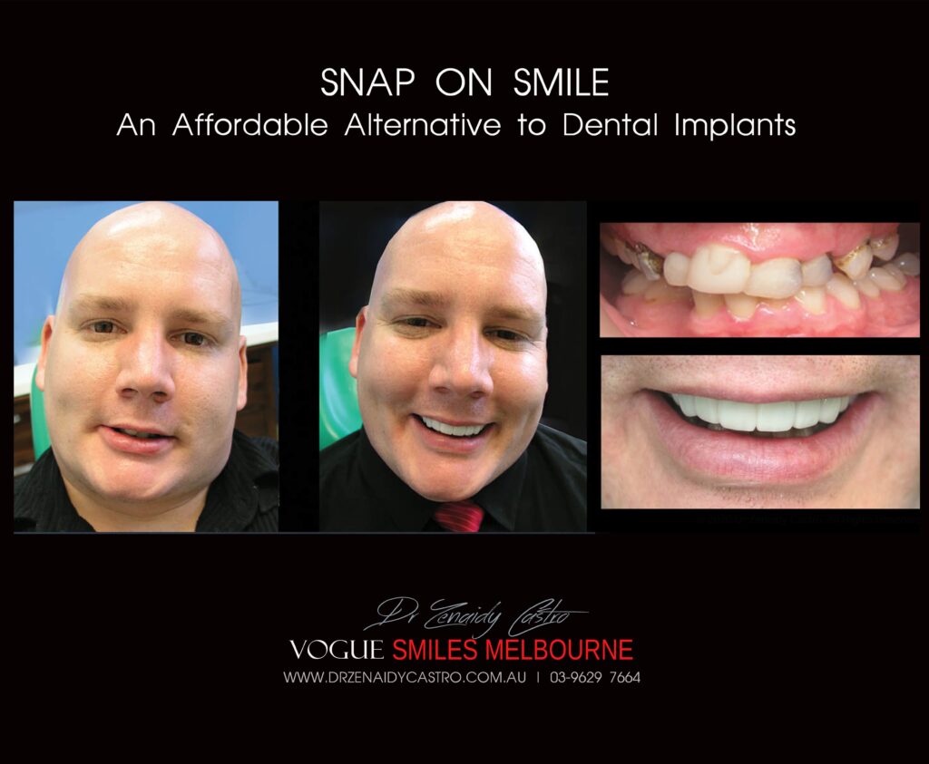 AFFORDABLE-COSMETIC-DENTISTRY-MAKEOVER-WITH-SNAP-ON-SMILE-MELBOURNE-19_1-scaled.jpg