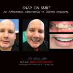 AFFORDABLE-COSMETIC-DENTISTRY-MAKEOVER-WITH-SNAP-ON-SMILE-MELBOURNE-19_1-scaled.jpg