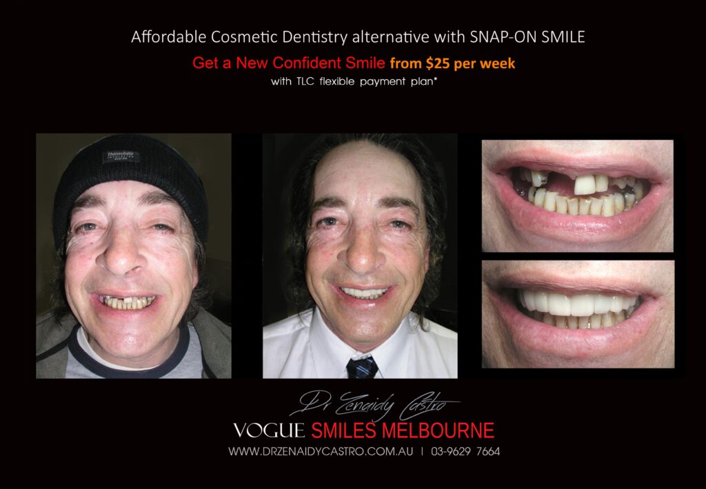 AFFORDABLE-COSMETIC-DENTISTRY-MAKEOVER-WITH-SNAP-ON-SMILE-MELBOURNE-2-scaled.jpg