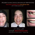 AFFORDABLE-COSMETIC-DENTISTRY-MAKEOVER-WITH-SNAP-ON-SMILE-MELBOURNE-2-scaled.jpg