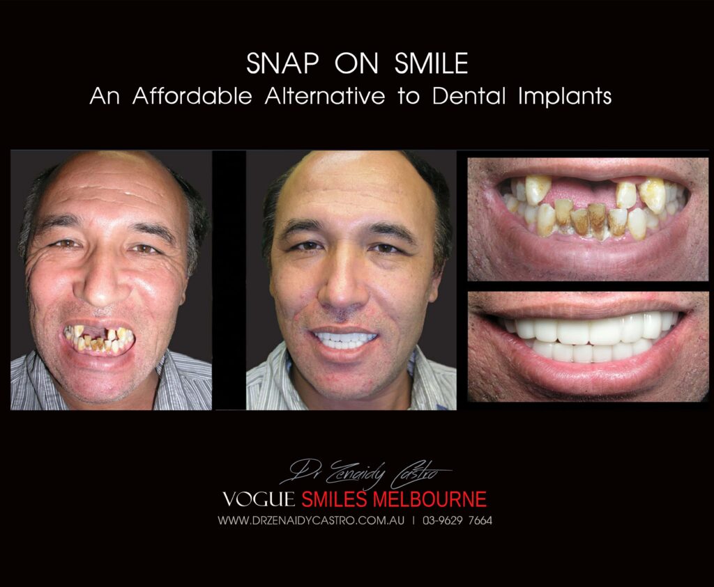 SNAP ON SMILE