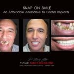 AFFORDABLE-COSMETIC-DENTISTRY-MAKEOVER-WITH-SNAP-ON-SMILE-MELBOURNE-20-scaled.jpg