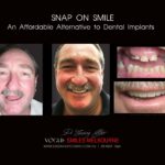 AFFORDABLE-COSMETIC-DENTISTRY-MAKEOVER-WITH-SNAP-ON-SMILE-MELBOURNE-21-scaled.jpg