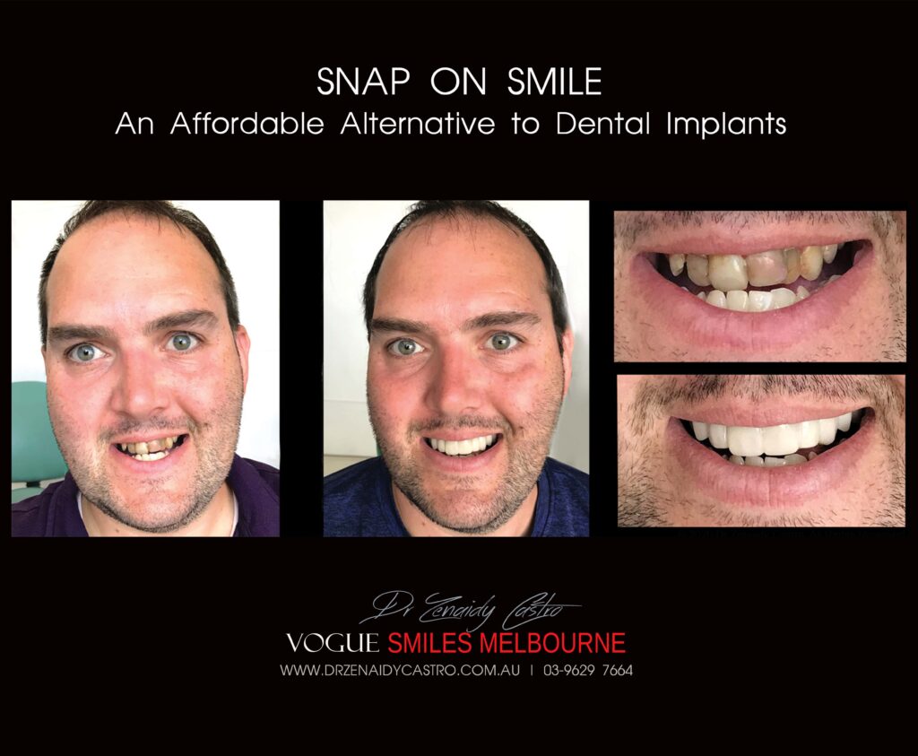 Before & After Pictures of Snap on Smile in Melbourne