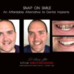 Before & After Pictures of Snap on Smile in Melbourne