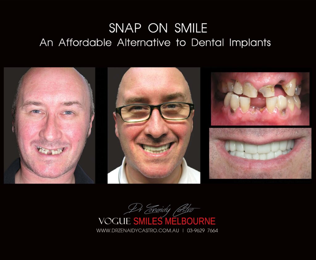 AFFORDABLE-COSMETIC-DENTISTRY-MAKEOVER-WITH-SNAP-ON-SMILE-MELBOURNE-23-scaled.jpg