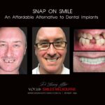 AFFORDABLE-COSMETIC-DENTISTRY-MAKEOVER-WITH-SNAP-ON-SMILE-MELBOURNE-23-scaled.jpg