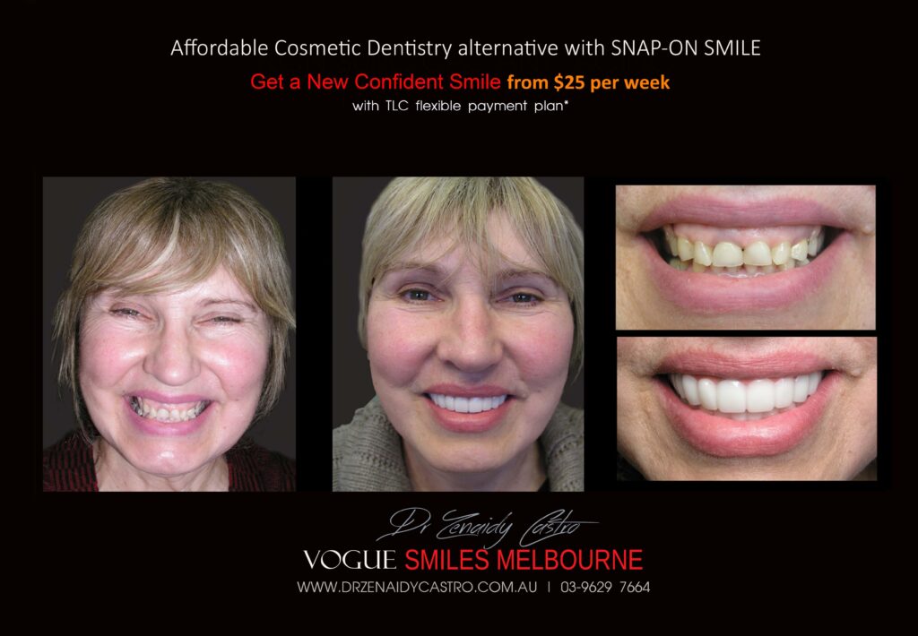 AFFORDABLE-COSMETIC-DENTISTRY-MAKEOVER-WITH-SNAP-ON-SMILE-MELBOURNE-3-scaled.jpg