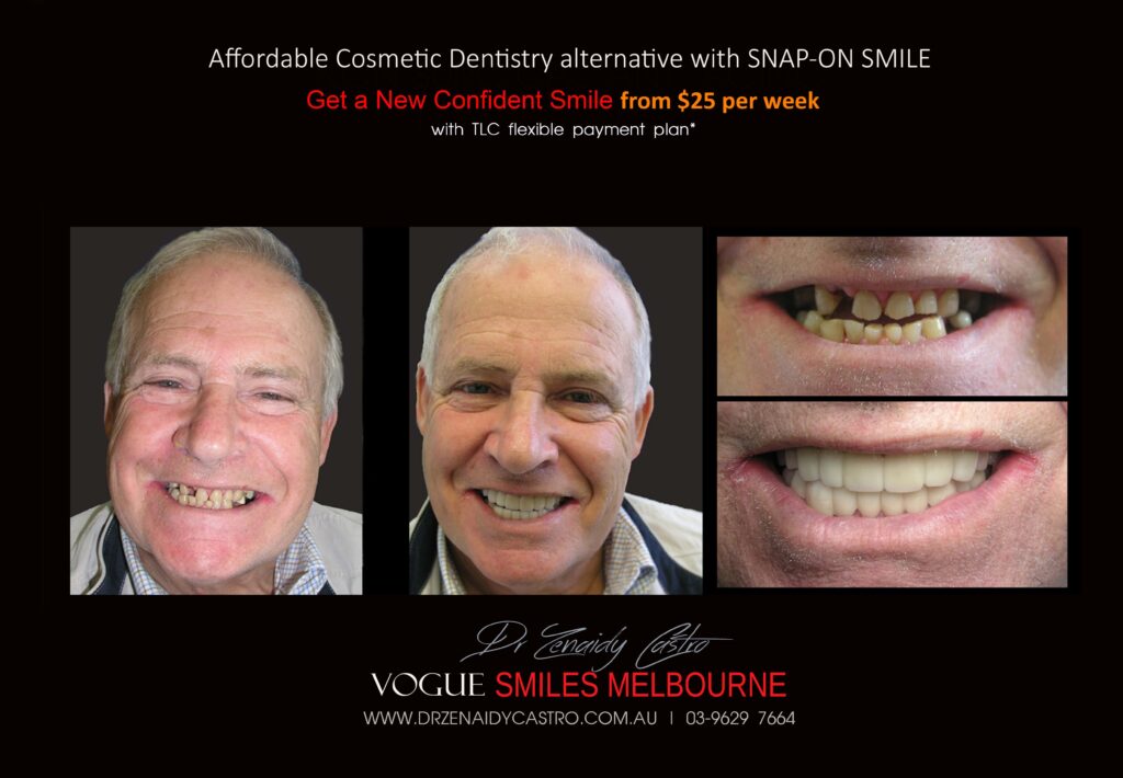 AFFORDABLE-COSMETIC-DENTISTRY-MAKEOVER-WITH-SNAP-ON-SMILE-MELBOURNE-4-scaled.jpg