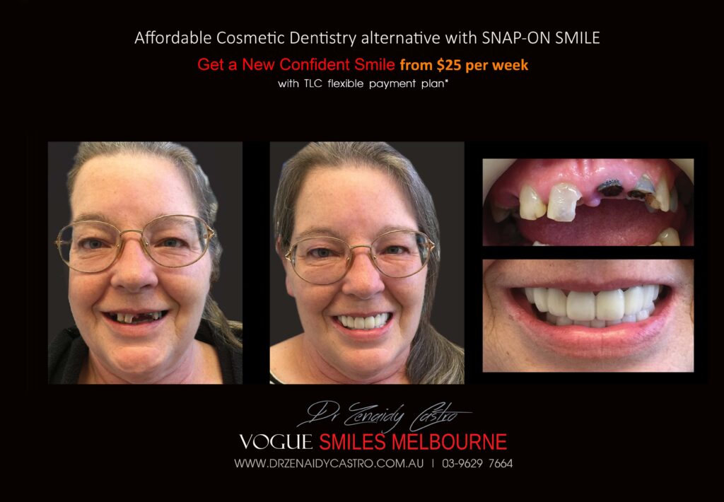 AFFORDABLE-COSMETIC-DENTISTRY-MAKEOVER-WITH-SNAP-ON-SMILE-MELBOURNE-5-scaled.jpg