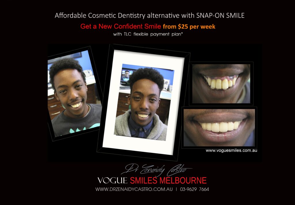 AFFORDABLE-COSMETIC-DENTISTRY-MAKEOVER-WITH-SNAP-ON-SMILE-MELBOURNE-7-scaled.jpg