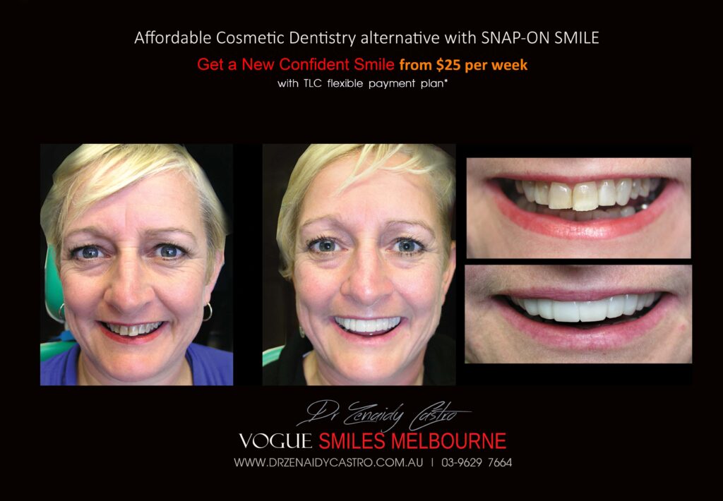 AFFORDABLE-COSMETIC-DENTISTRY-MAKEOVER-WITH-SNAP-ON-SMILE-MELBOURNE-8-scaled.jpg