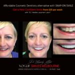 AFFORDABLE-COSMETIC-DENTISTRY-MAKEOVER-WITH-SNAP-ON-SMILE-MELBOURNE-8-scaled.jpg
