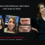 AFFORDABLE-COSMETIC-DENTISTRY-MAKEOVER-WITH-SNAP-ON-SMILE-MELBOURNE-9.jpg