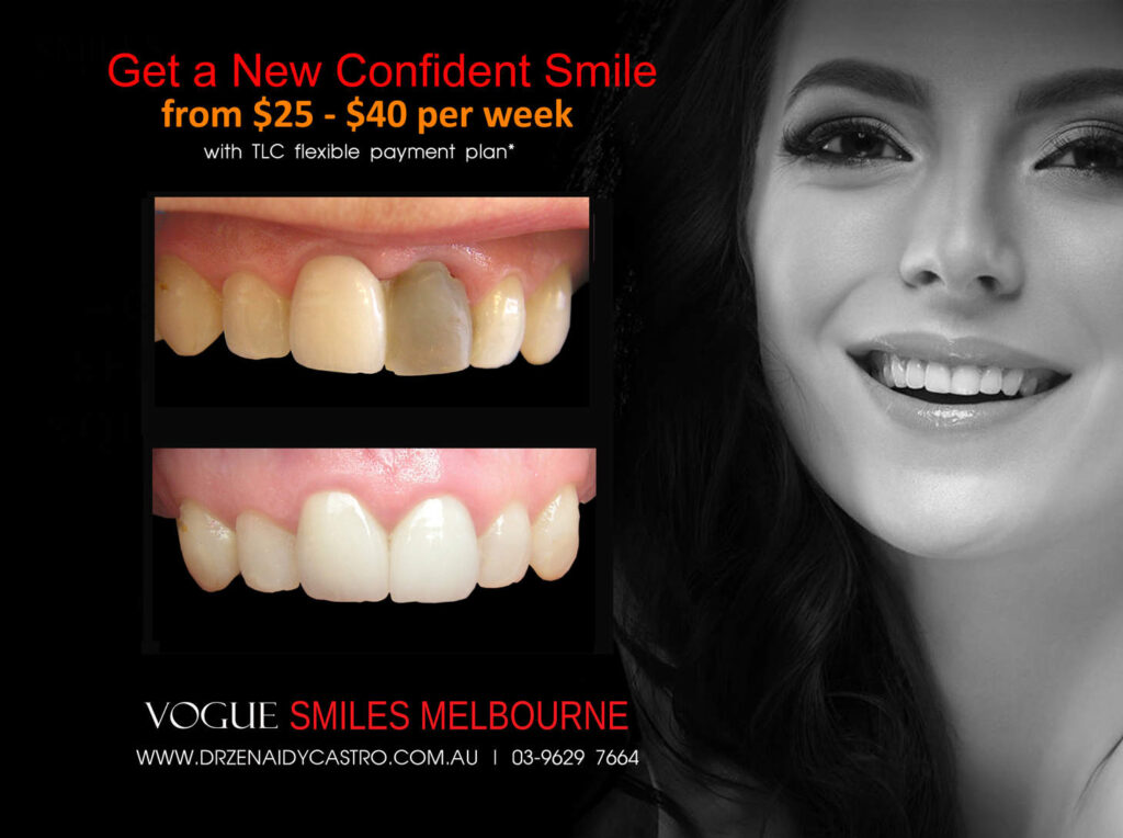BLACK-TOOTH-DEAD-FRONT-TOOTH-MAKEOVERS-MELBOURNE-1.jpg