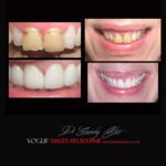 BLACK-TOOTH-DEAD-FRONT-TOOTH-MAKEOVERS-MELBOURNE-13.jpg
