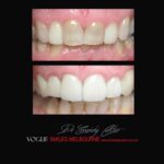 BLACK-TOOTH-DEAD-FRONT-TOOTH-MAKEOVERS-MELBOURNE-3.jpg