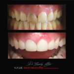 BLACK-TOOTH-DEAD-FRONT-TOOTH-MAKEOVERS-MELBOURNE-4-scaled.jpg
