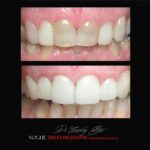 BLACK-TOOTH-DEAD-FRONT-TOOTH-MAKEOVERS-MELBOURNE-5-scaled.jpg