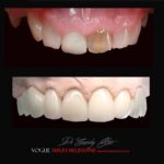 BLACK-TOOTH-DEAD-FRONT-TOOTH-MAKEOVERS-MELBOURNE-6-scaled.jpg