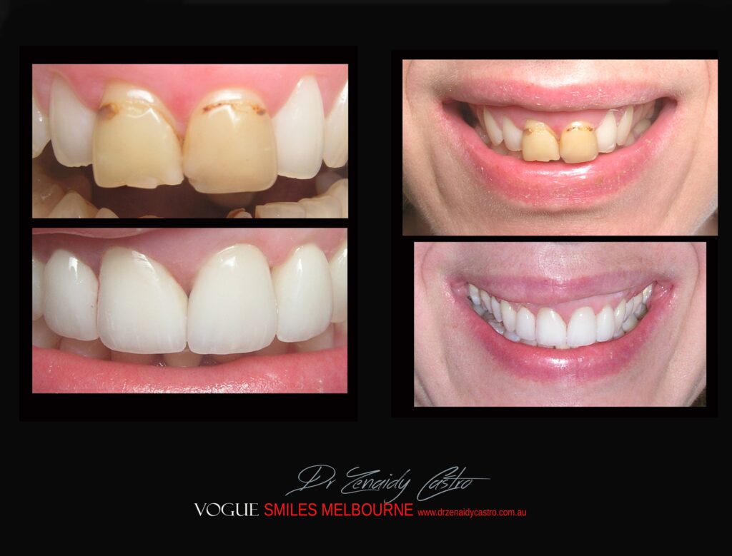 BLACK-TOOTH-DEAD-FRONT-TOOTH-MAKEOVERS-MELBOURNE-7-scaled.jpg