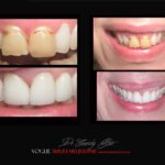 BLACK-TOOTH-DEAD-FRONT-TOOTH-MAKEOVERS-MELBOURNE-7-scaled.jpg